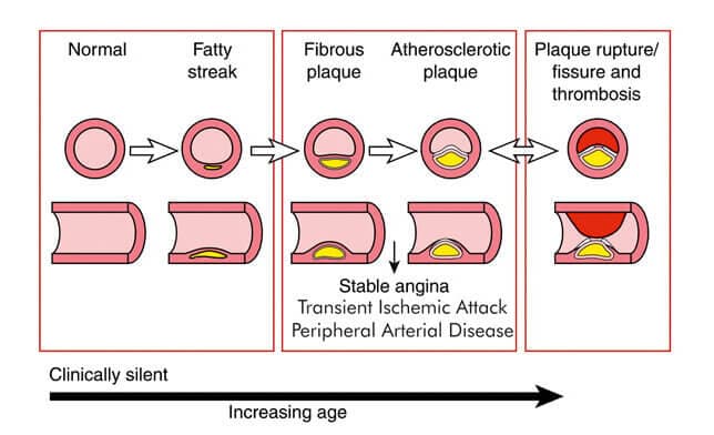 Atherosclerosis